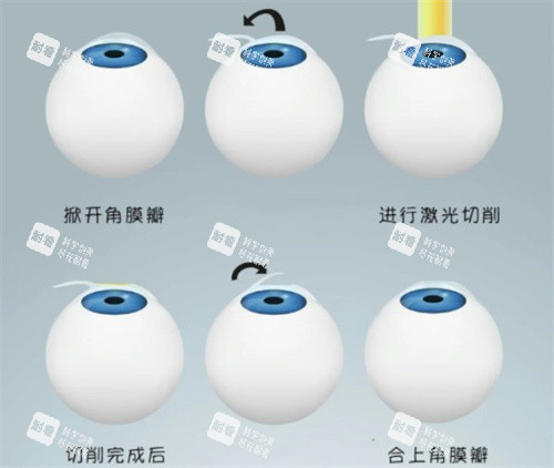 半飞秒手术过程