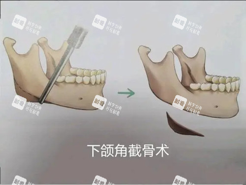 下颌角截骨术卡通示意图