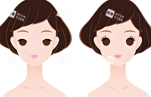 双眼皮前后对比图