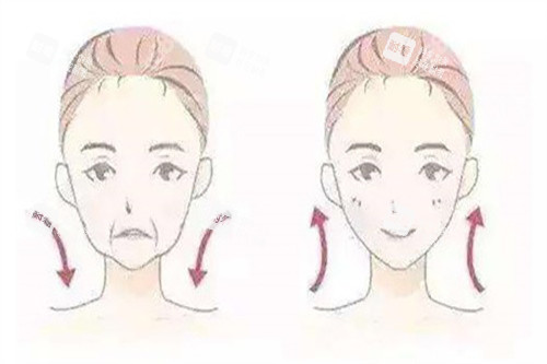 拉皮面部提升对比卡通示意图