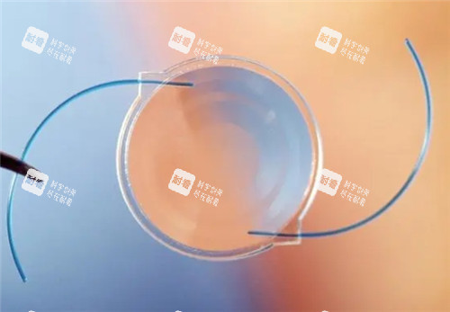白内障晶体照片