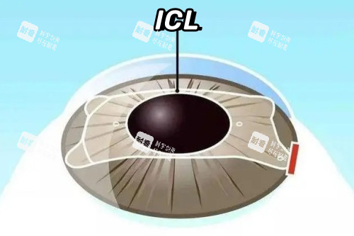 ICL晶体植入卡通一览图