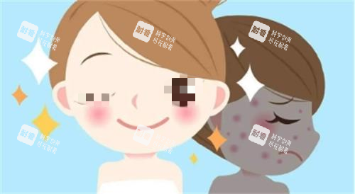 光子嫩肤成效图