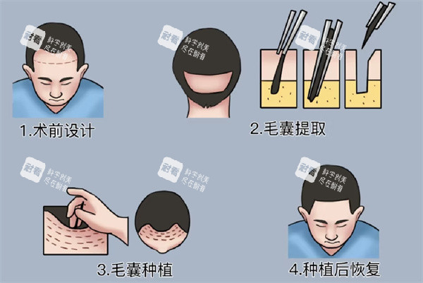 植发手术