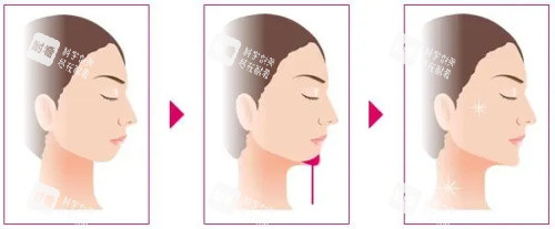 垫下巴的过程图