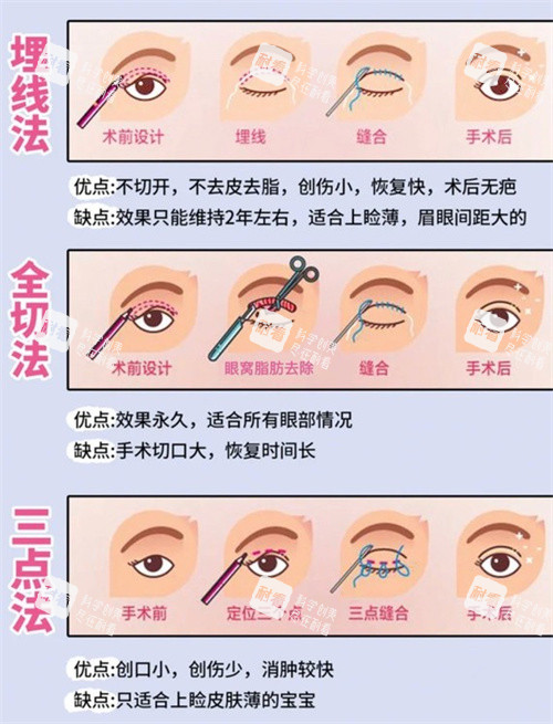 双眼皮三种手术方式动画