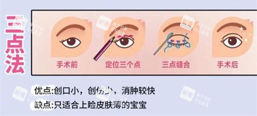 双眼皮手术三点法动画演示图