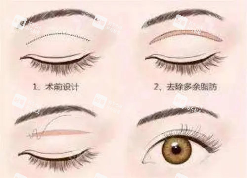 全切双眼皮卡通示意图