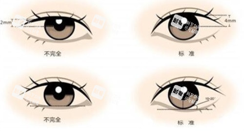 双眼皮示意图