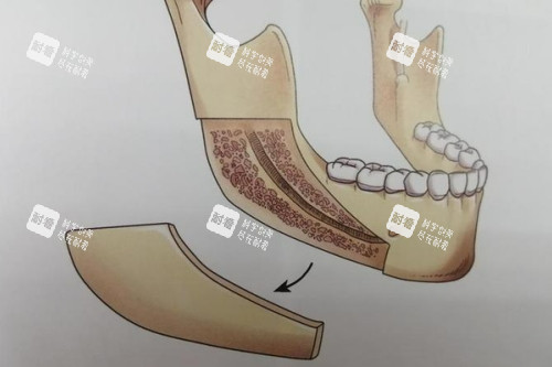 下颌角截骨卡通图