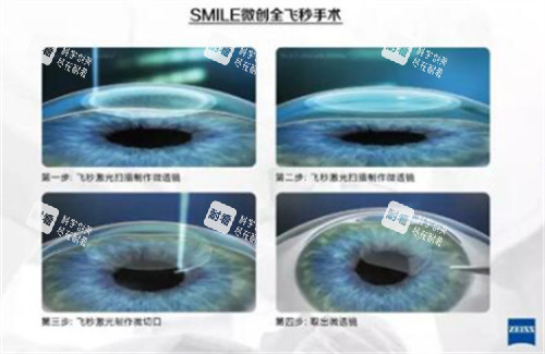 全飞秒手术过程图解