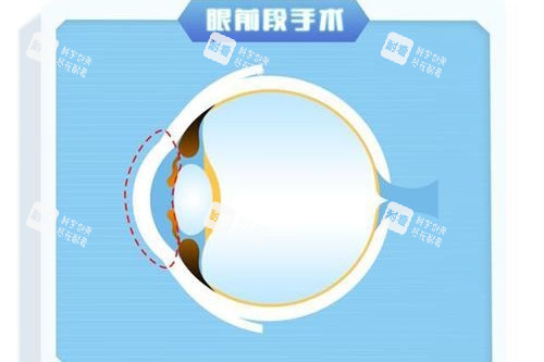 眼前段近视手术示意图
