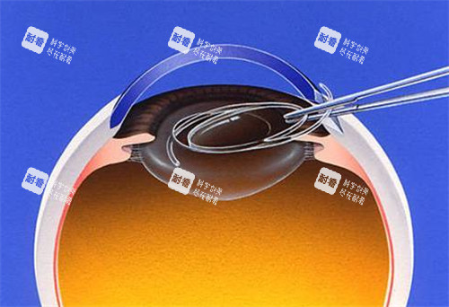 白内障晶体展示图