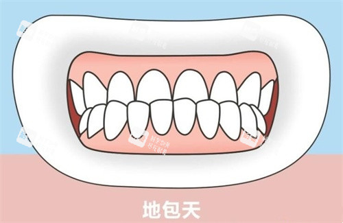 地包天示意图