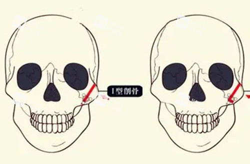 颧骨磨骨整形卡通示意图