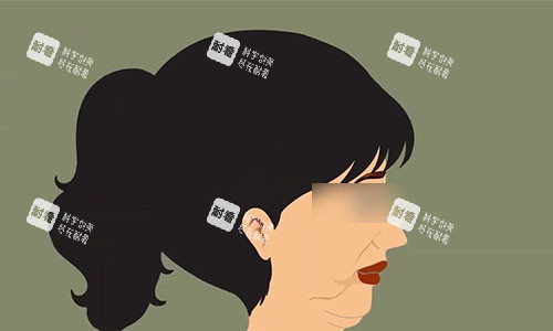 拉皮手术前的动画示意图