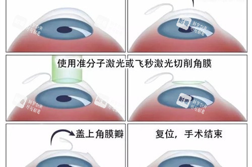 近视眼手术流程展示