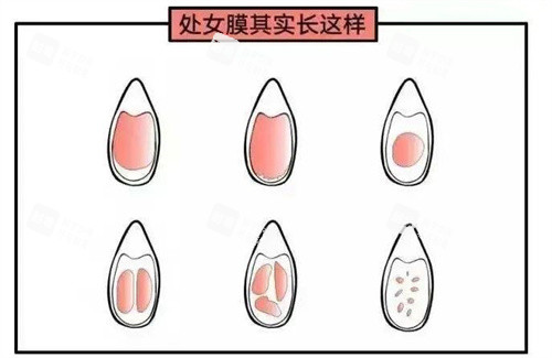 处女膜动画演示图