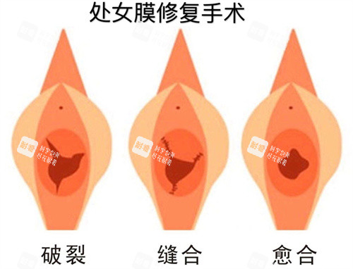 处女膜修复手术过程动画演示图