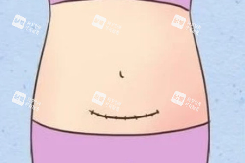 剖腹产疤痕图