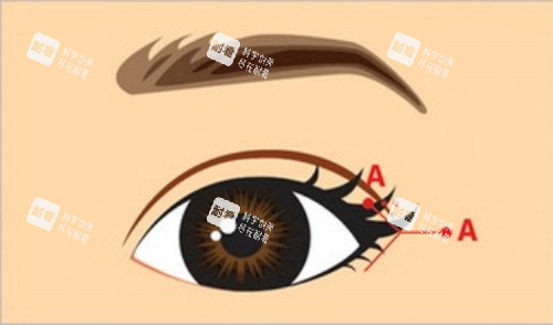 割眼角前设计图