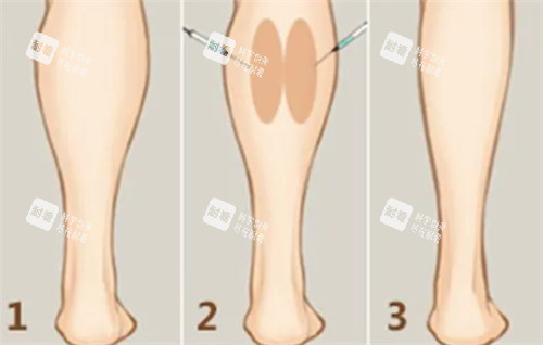 瘦腿注射前后变化