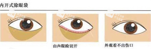 内切法祛眼袋手术过程