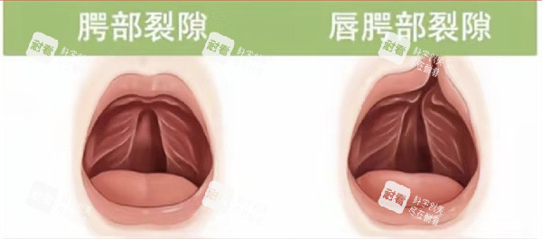 唇腭裂