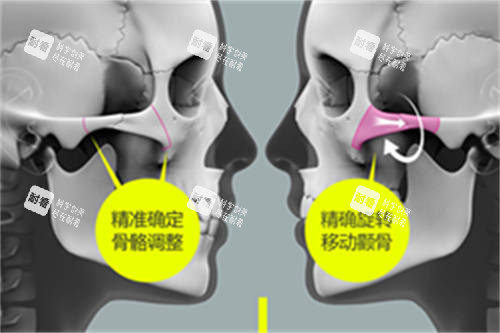 北京圣嘉新医疗美容医院张笑天颧骨颧弓整形示意图