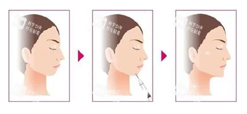 玻尿酸丰下巴前后的区别