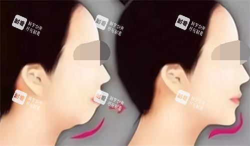 玻尿酸丰下巴后的成效