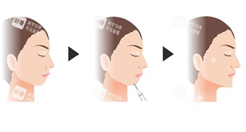 玻尿酸丰下巴示意图