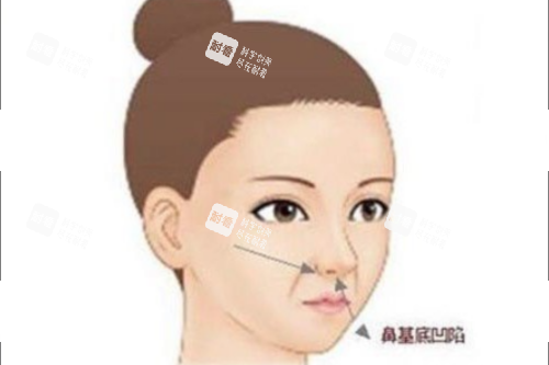 鼻基底凹陷