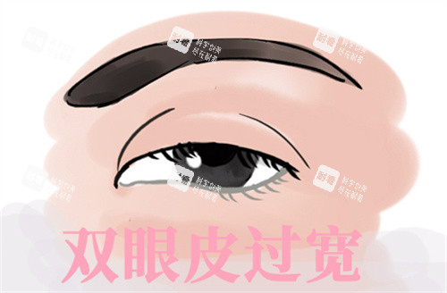 双眼皮过宽修复