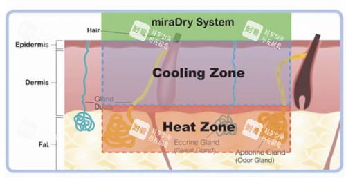 miraDry清新微波正规吗