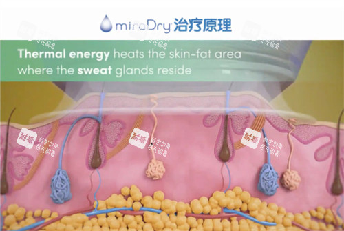 miraDry清新微波治疗原理