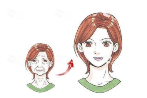 面部拉皮提升卡通对比图