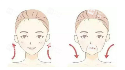 面部提升