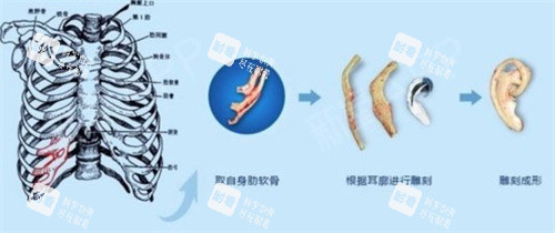 耳再造手术肋软骨雕刻