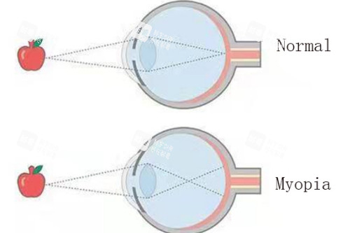 近视眼与正常眼对比
