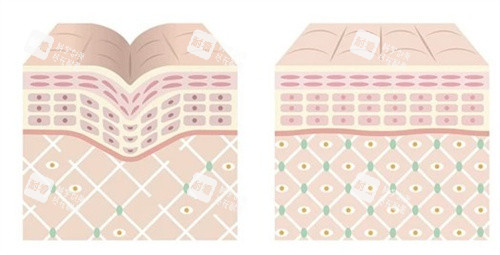 熊猫针注射原理