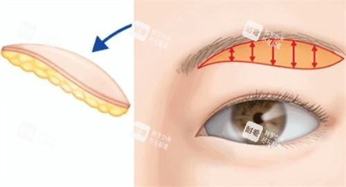 提眉手术切口 提眉手术切口