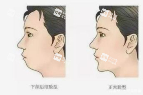 正常脸型和下巴后缩脸型对比图