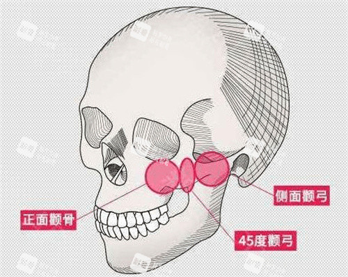 颧骨整形