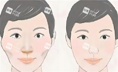 颧骨内推术前后对比动画图