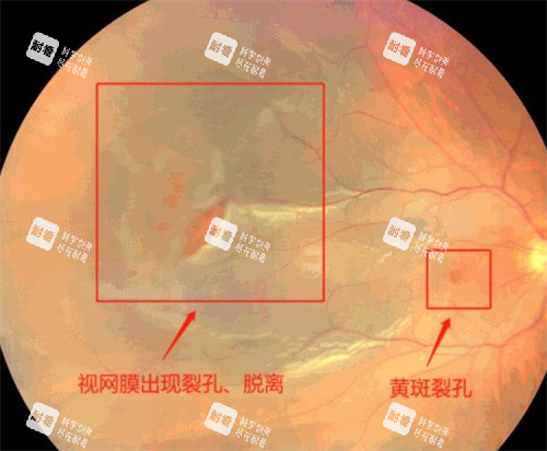 孔源性视网膜脱离的不同病症图
