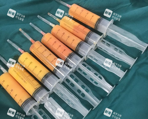 吸脂手术抽出来的脂肪照片