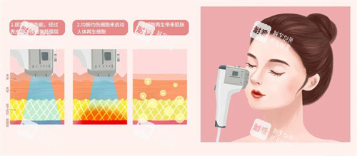 超声炮