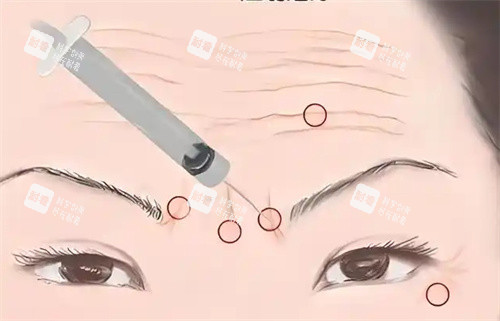 <span class='highlight'>除皱针</span>