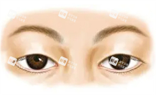 未做手术前的上眼睑下垂